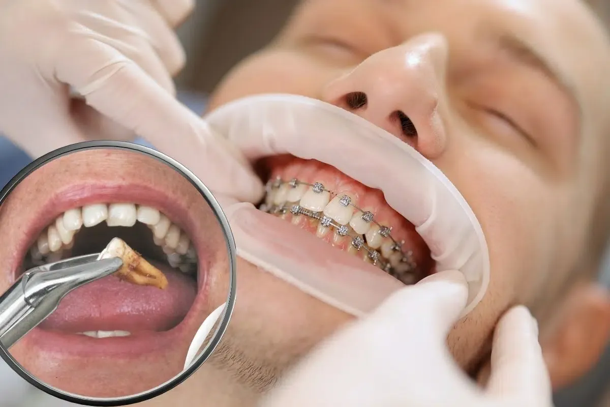 How Painful Is Tooth Extraction? Real Patient Experiences Explained
