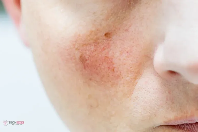 How to Get Rid of Redness on Face | Houston USA