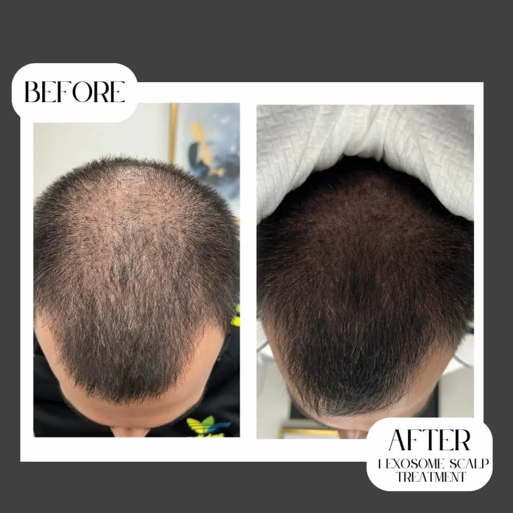 Exosome Therapy for Hair Loss – A New Approach Worth Understanding