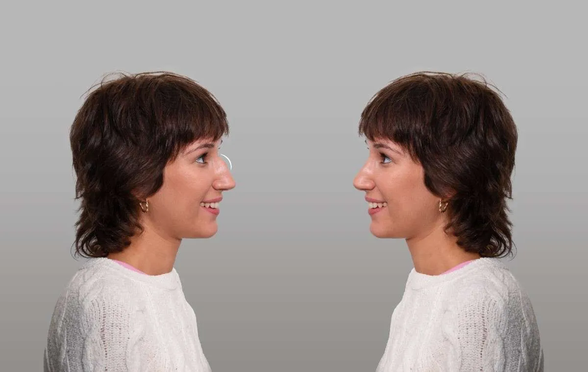 Is Nose Surgery Permanent? What You Need to Know