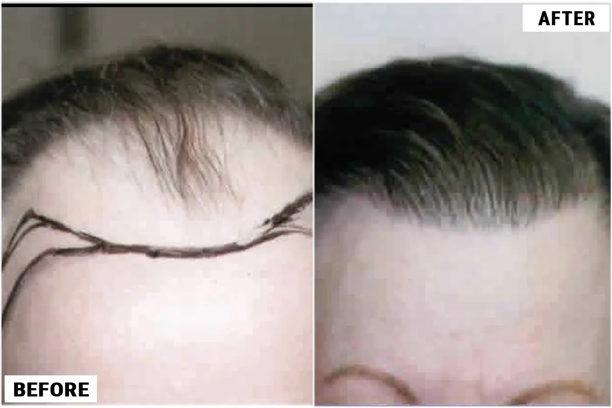 نتائج زراعة الشعر قبل وبعد: شهادات حقيقية من عملائنا