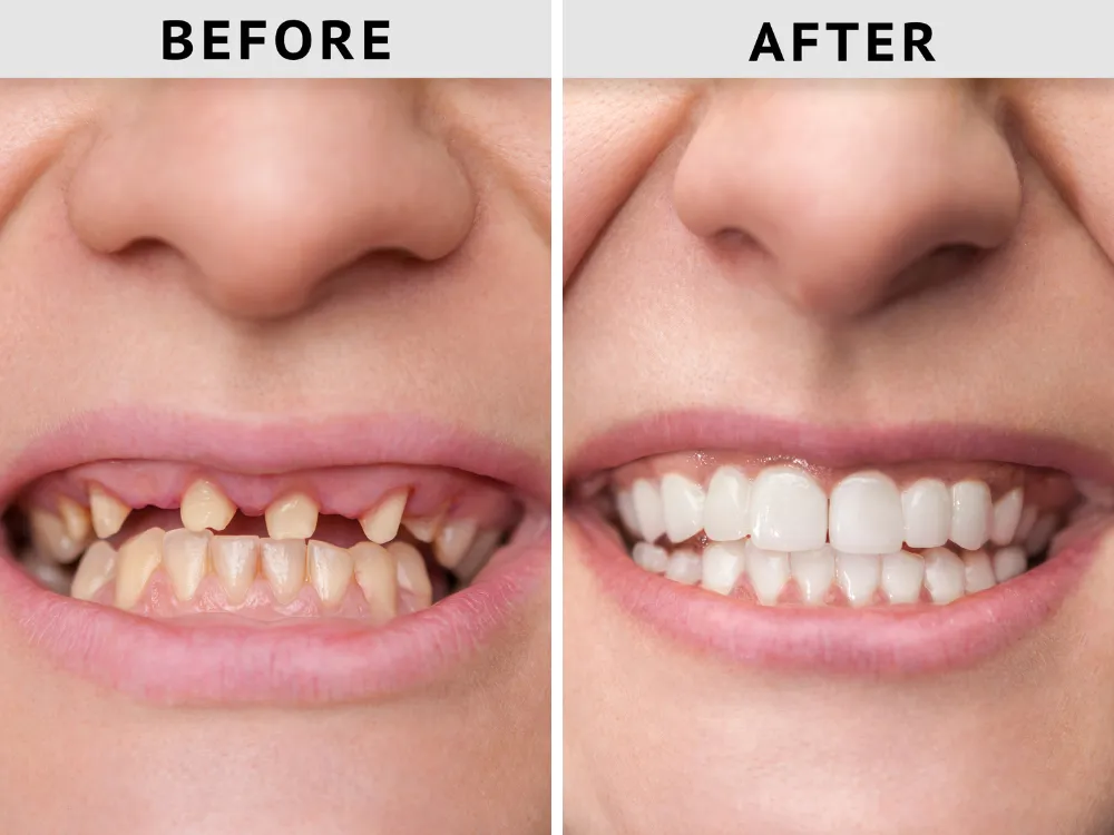 Is Dental Crown Cost Worth It? Long-Term Benefits Explained