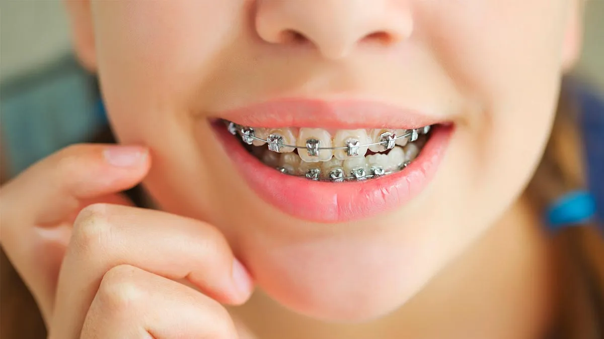 Can Braces Treatment Correct Bite Problems?