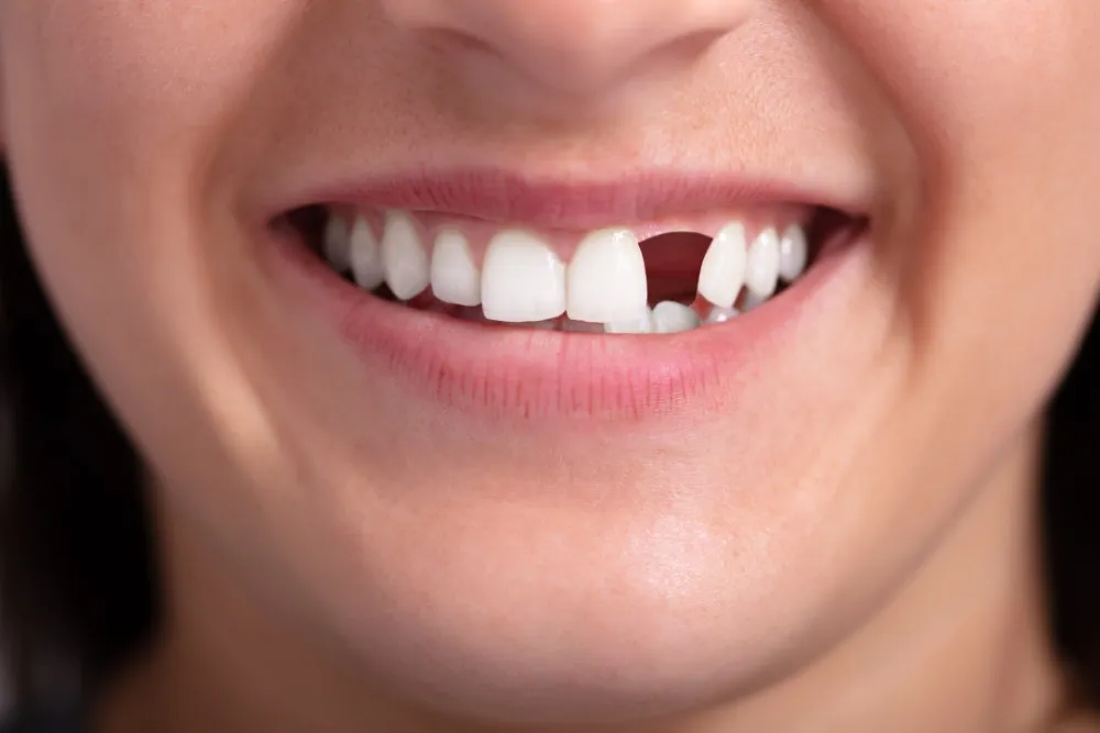 Affordable Tooth Replacement Options: What You Should Know