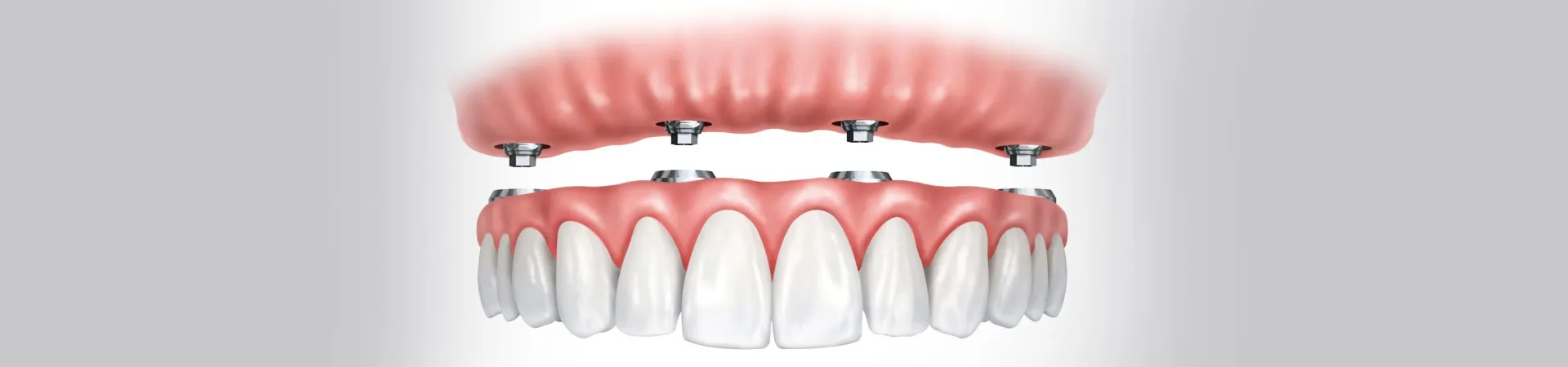 All on 4 Dental Implant in Vasai: A Modern Solution for Full Smile Rehabilitation
