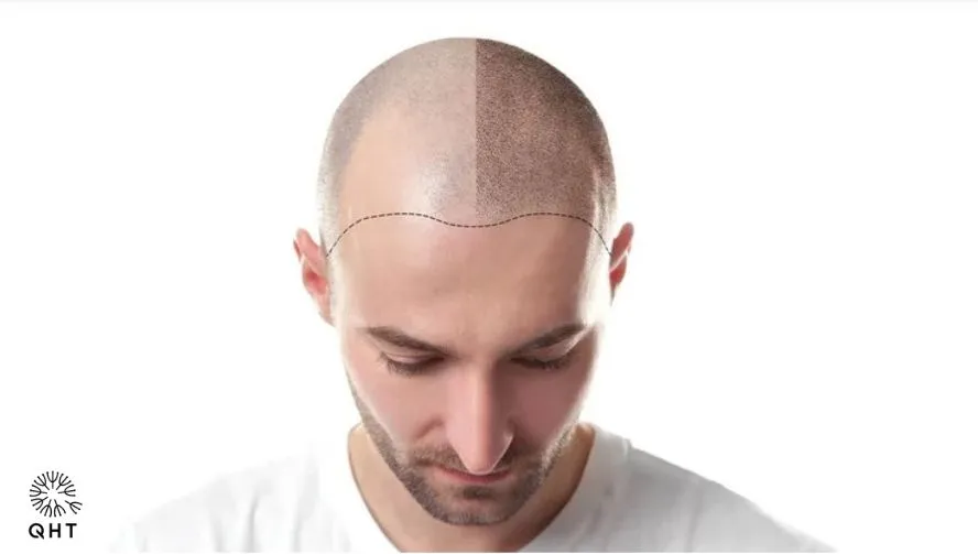 The Gut Hair Connection: How Digestive Health Influences Hair Loss and Transplant Outcomes : QHT Clinic Delhi