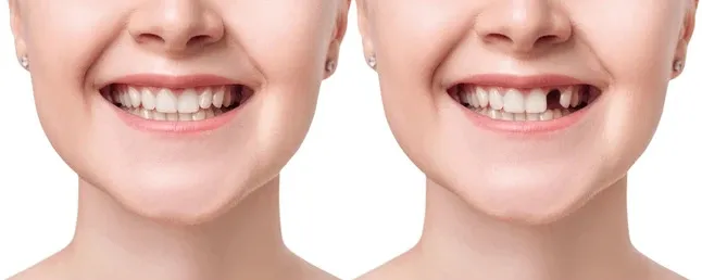 Dental Implants Forest Hills: Complete Guide for First-Time Patients