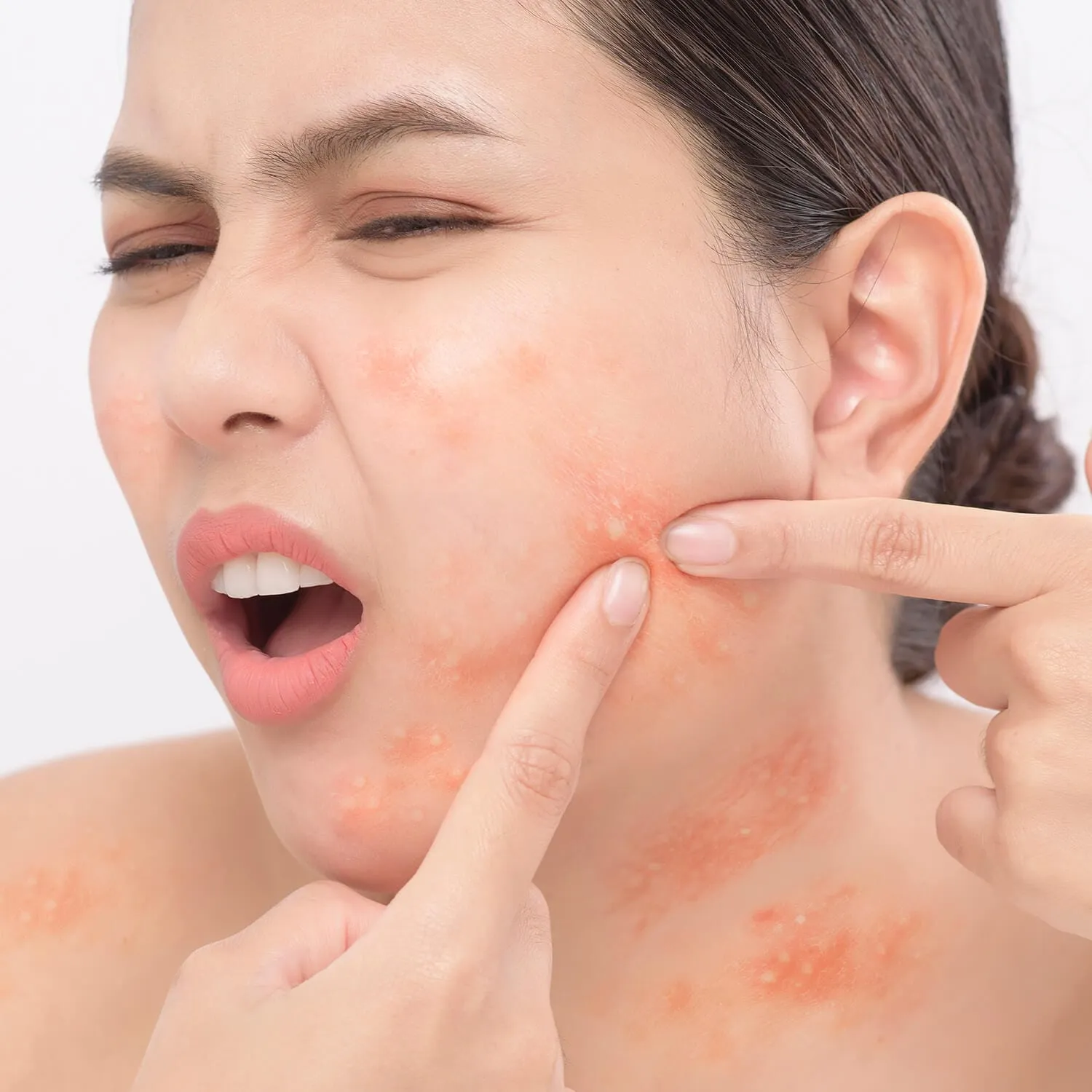Complete Guide to Acne Scar Treatment in Chennai