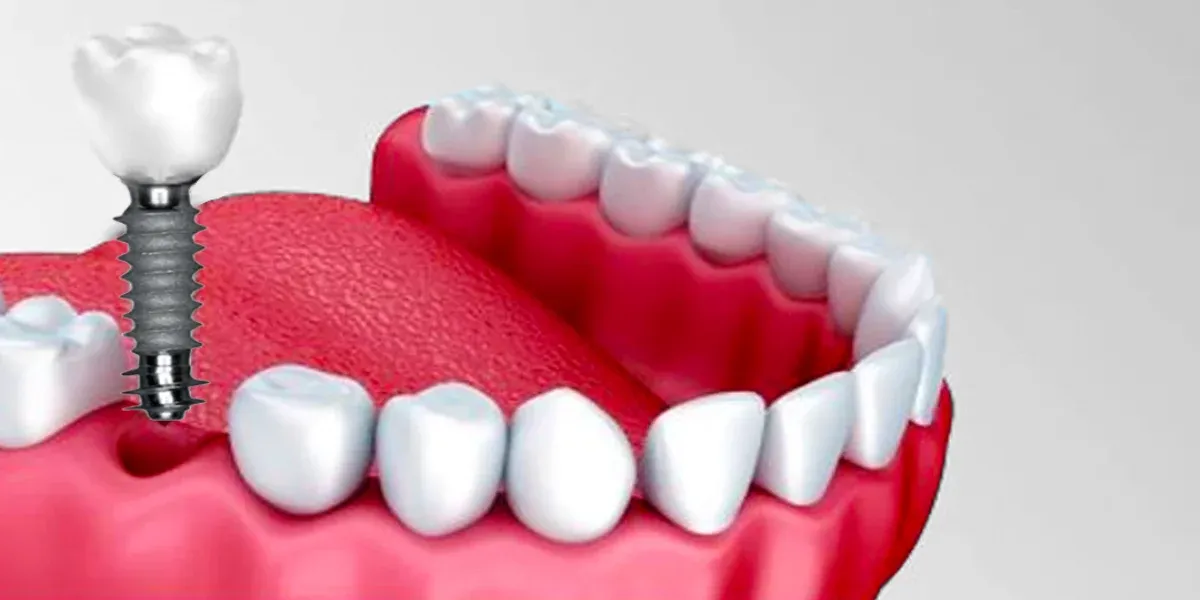 Dental Implants for Diabetic Patients: Safety, Risks, and Benefits Explained