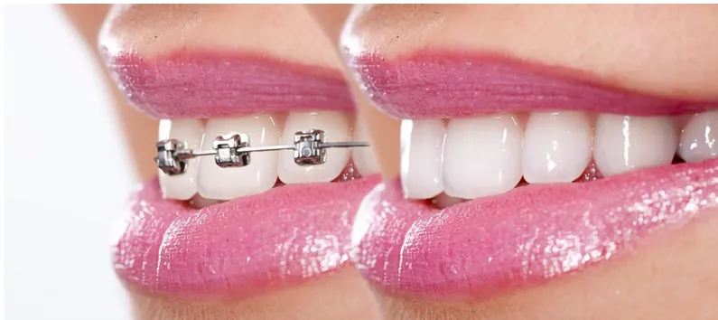 Who Provides Affordable Braces & Fastest Invisalign