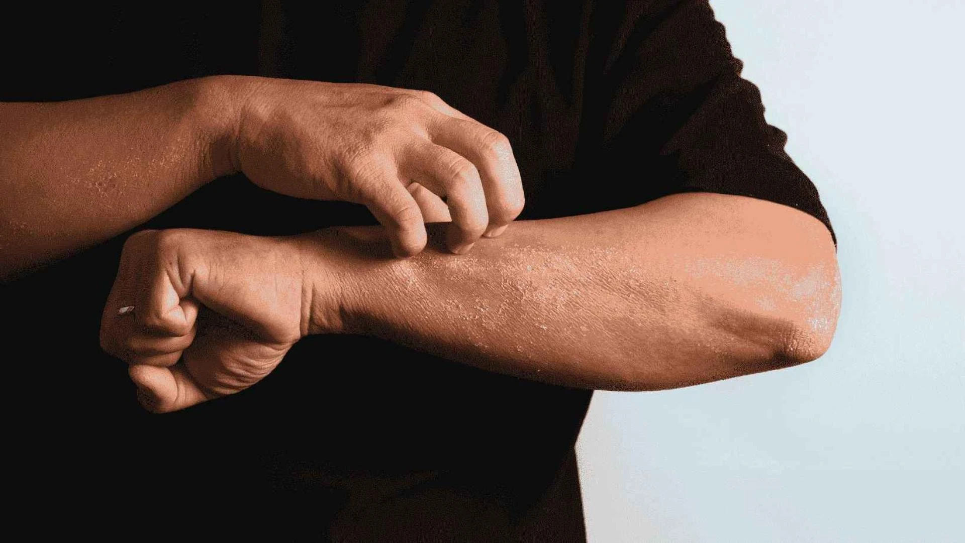 What are common skin care diseases and preventive treatment?