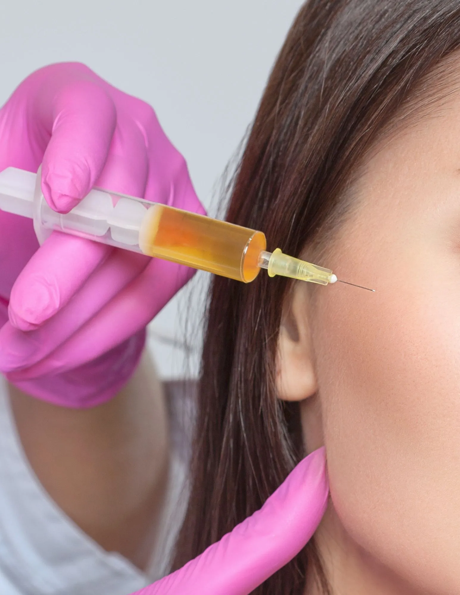 How PRP Facial Can Help Treat Acne Scars: A Comprehensive Guide