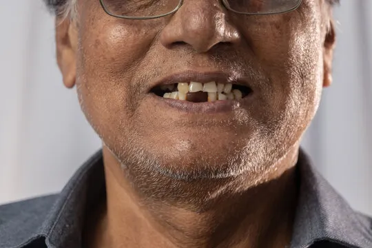 Do You Have Missing Teeth? Understand How Dental Implants Work