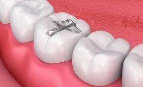 Dental Fillings: Restore Damaged Teeth Easily