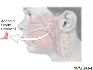 Adenoid Surgery Cost: A Complete Guide for Patients and Parents