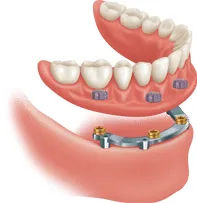 Transform your smile with implant dentures in Chatham-Kent