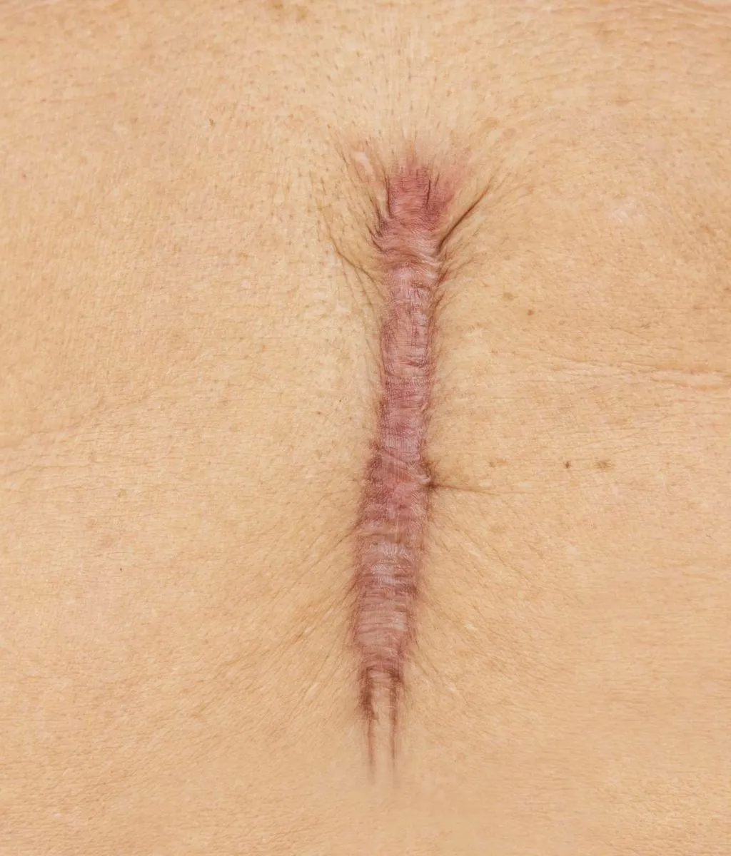 Keloids Ear vs Hypertrophic Scar What’s the Difference