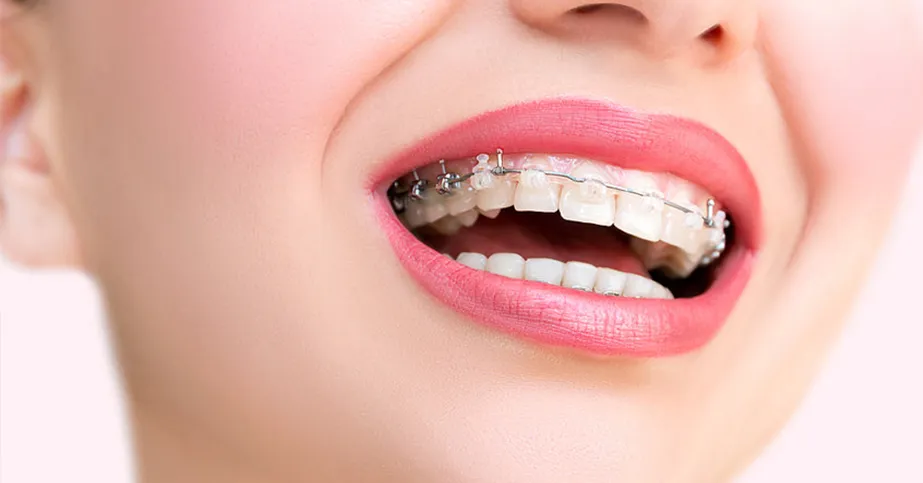 Invisalign Treatment: A Modern Way to Straighten Your Smile