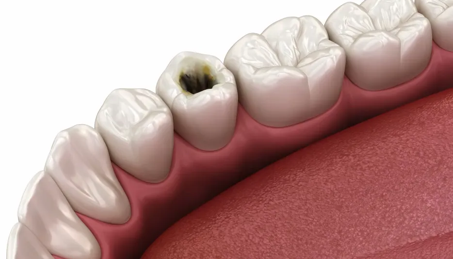 Jason Lam Dental全面解析杜牙根過程助你重拾健康自信笑容