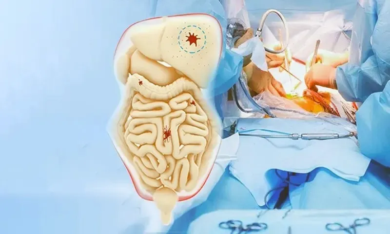 HIPEC Surgery in Delhi: A Breakthrough Treatment for Advanced GI Cancers