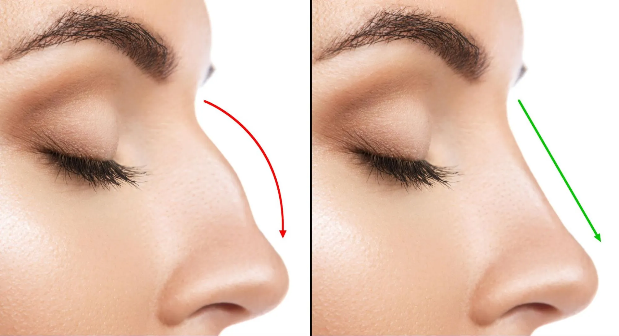 Rhinoplasty in Dubai – Advanced Nose Reshaping for Natural Results