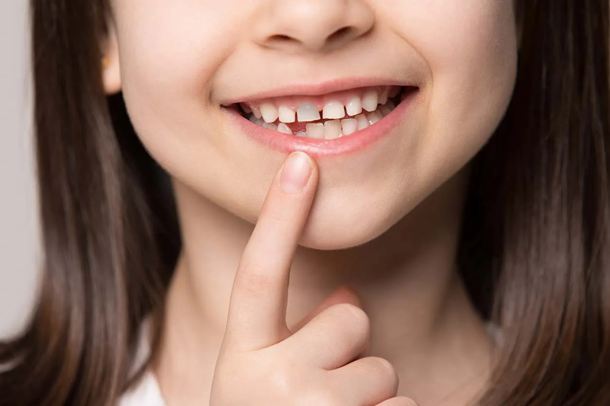 Little Smiles Matter: Expert Care for Teeth Grinding & Discolored Baby Teeth