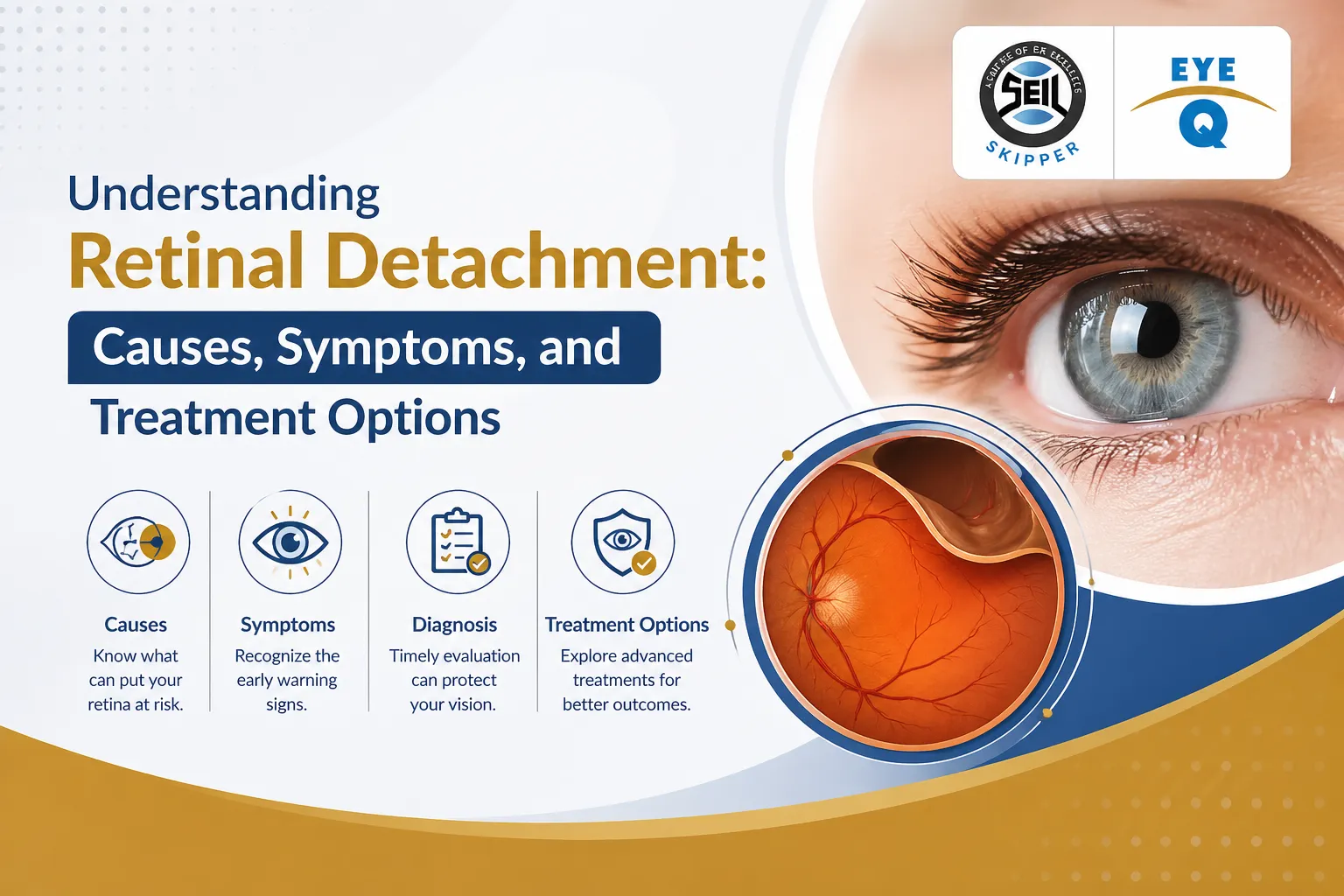 Understanding Retinal Detachment: Causes, Symptoms, and Treatment Options
