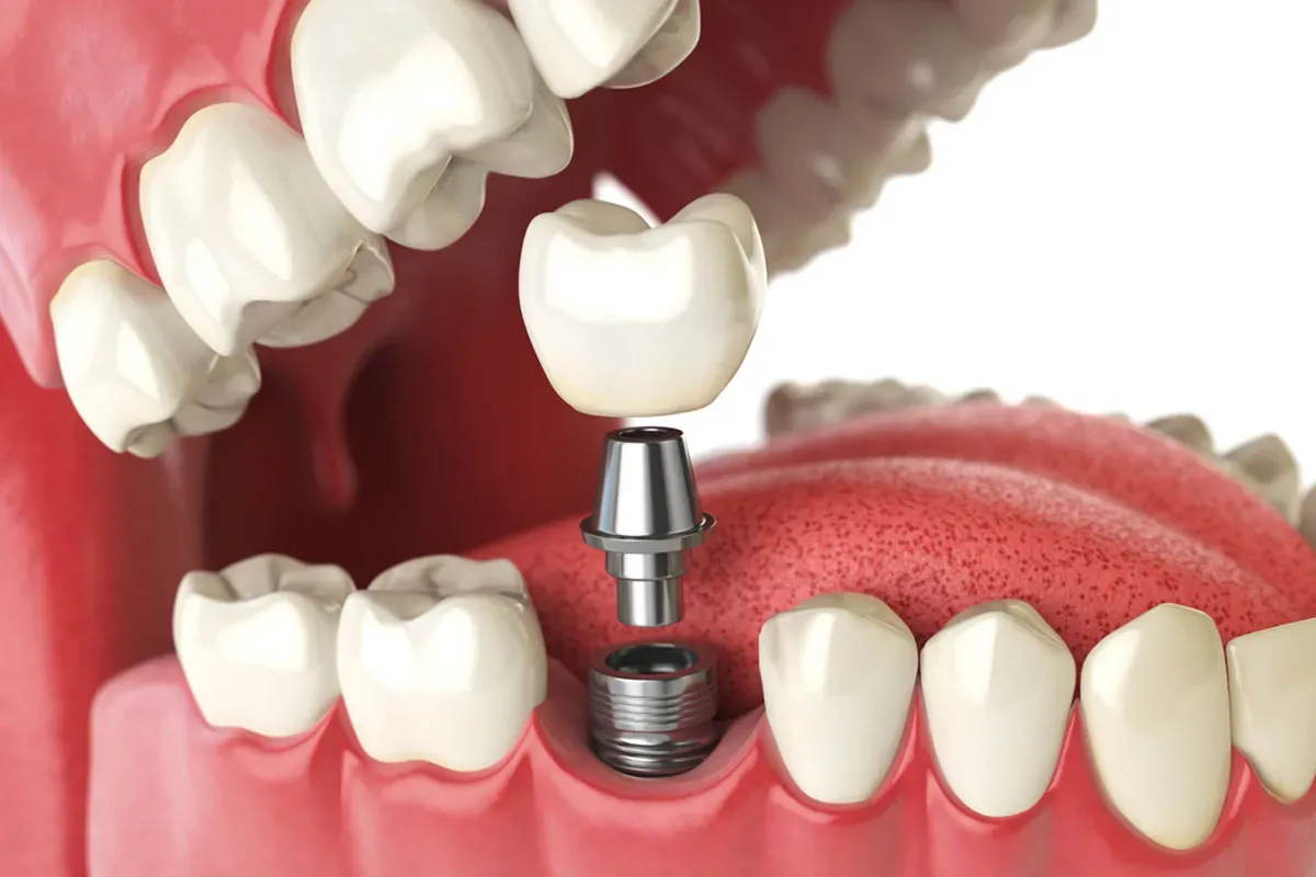 Dental Implant Cost in Crawfordville, FL – Options, Pricing & Savings