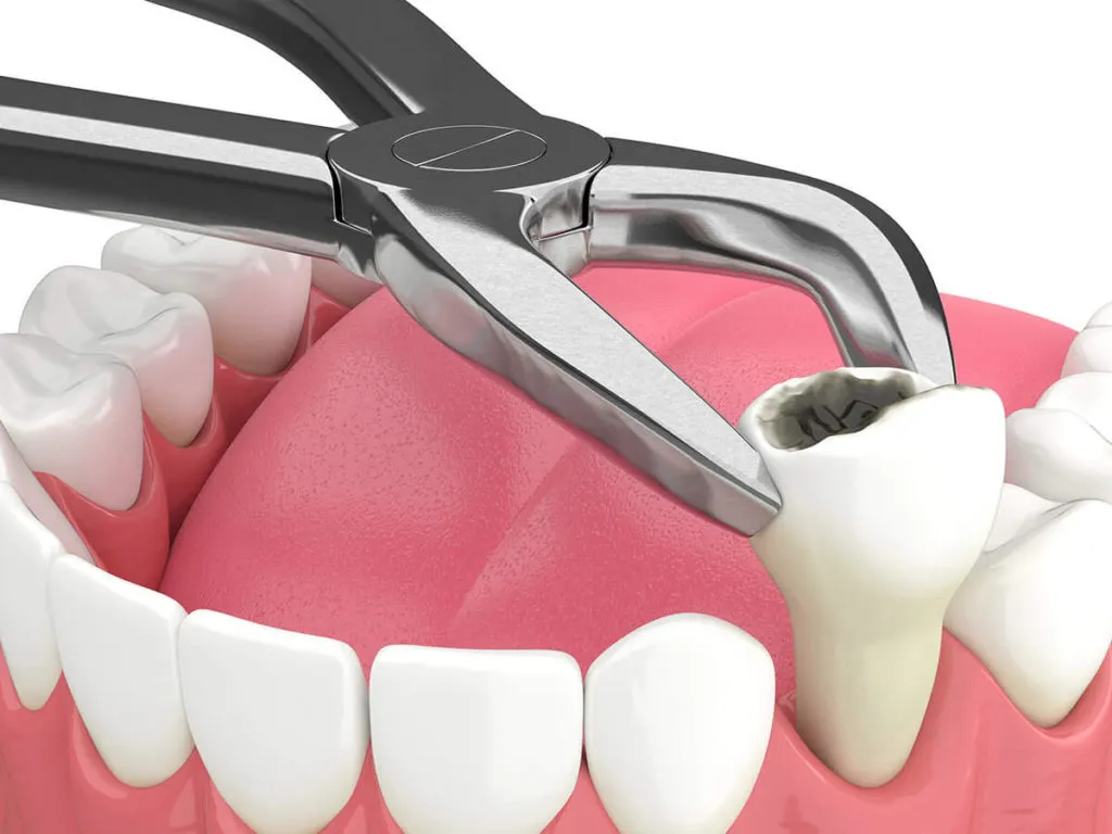 Best Tooth Extraction in Hayward, WI – Pain-Free Solutions