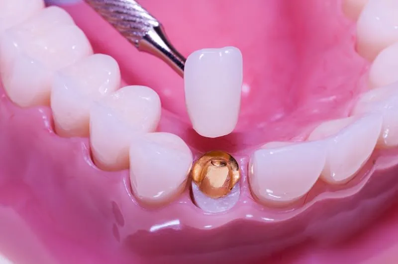 Dental Crowns Palatka, FL – Protect & Repair Damaged Teeth