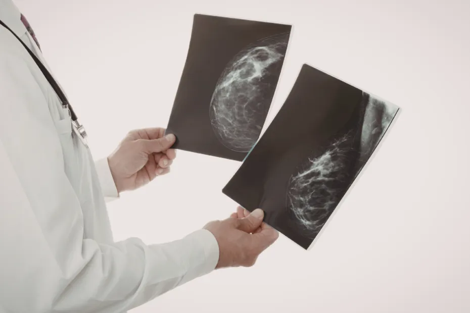 Why So Many South African Women Are Still Skipping Mammograms (And Why That Needs to Change)
