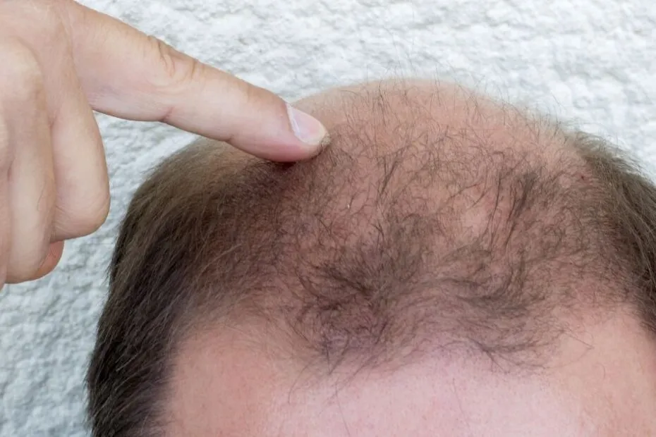 Hair Loss Is More Common Than You Think  Here Is What You Can Actually Do About It