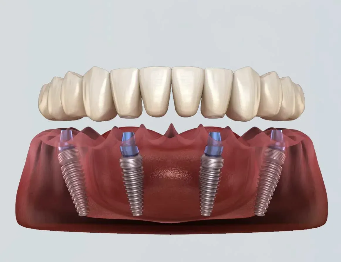 How All-on-4 Implants Provide Same-Day Teeth Replacement