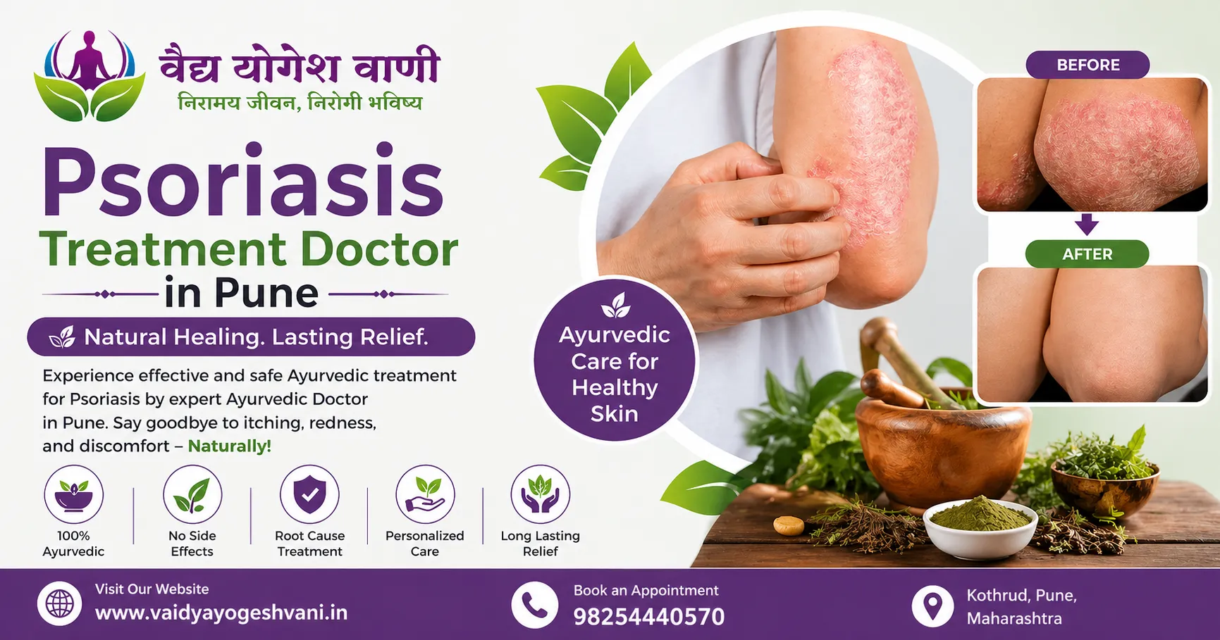 How to Choose Best Psoriasis Treatment Doctor in Pune Easily