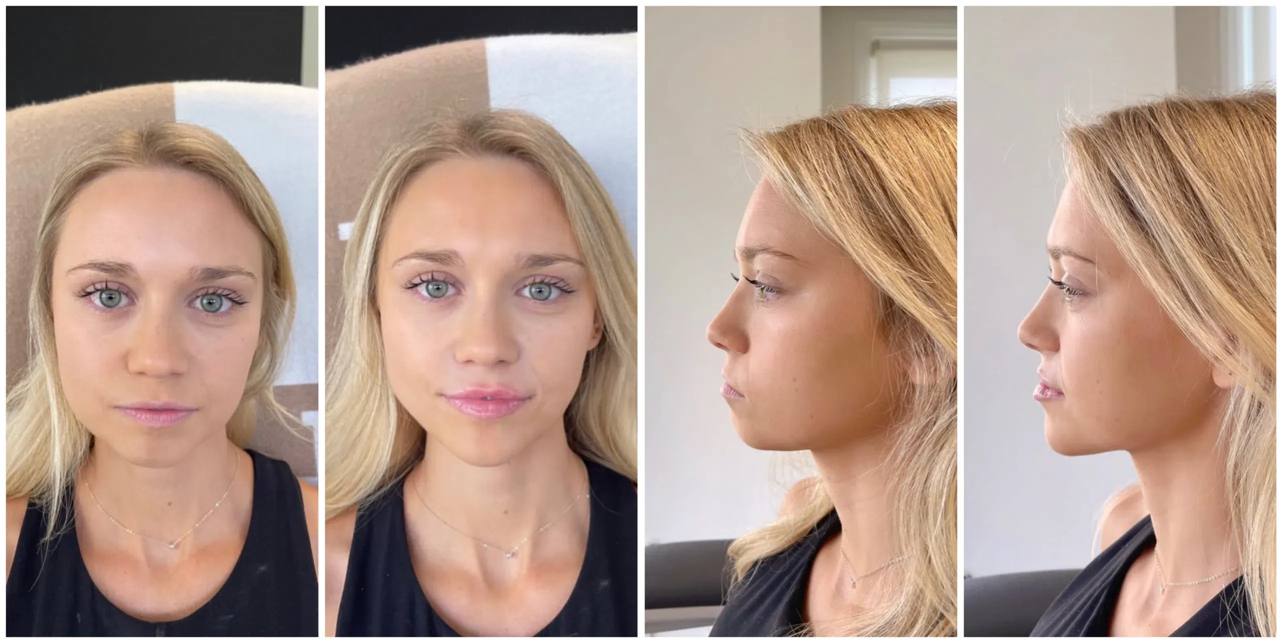 How Fillers Can Instantly Refresh Your Look Without Surgery