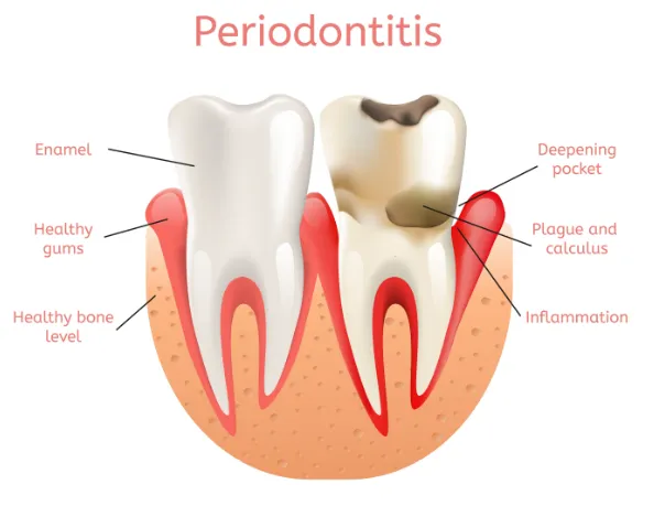 Where to Get the Best Periodontist in Tempe for Gum Disease Treatment