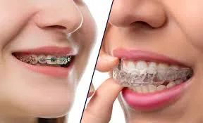 How Much Does Invisalign Cost in San Antonio, TX?