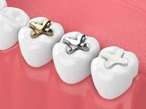 What Is a Tooth Colored Filling and Why Do You Need It?