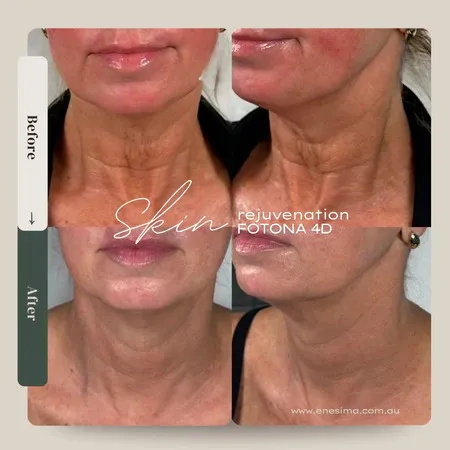 Is Fotona 4D Laser Face Treatment the Best Choice?
