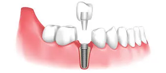 Where Can I Find Implant Specialists in Middle Village?
