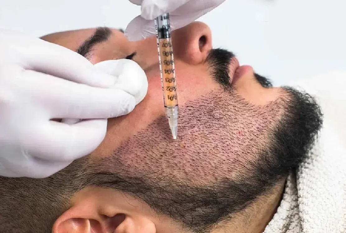 Tips To Take Care After Beard Transplant
