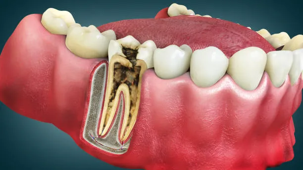 Everything You Need to Know About Root Canal in Santa Clarita: A Complete Guide