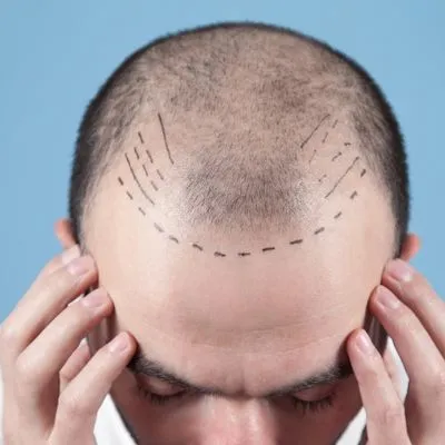 Pain-Free Hair Transplant: Myth or Reality in Modern Techniques