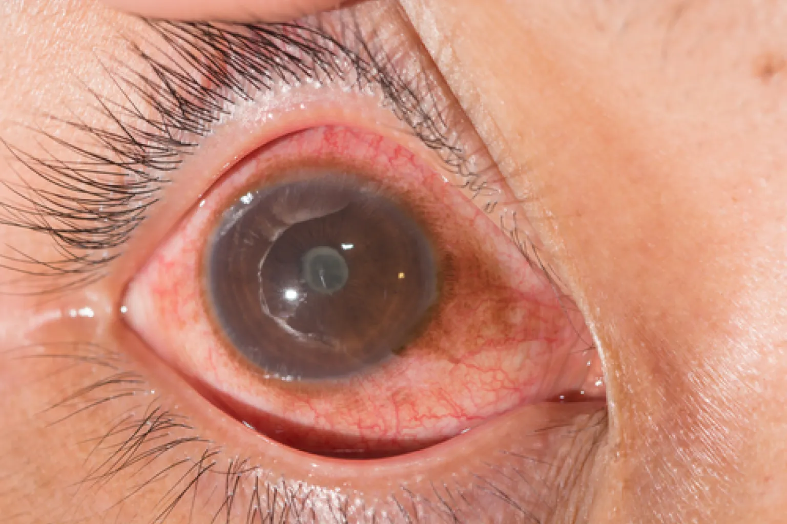 Uveitis Eye Treatment: Signs That You Need to Get It