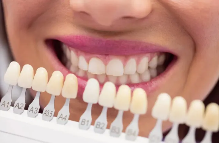 Veneers in Ajman: Achieve a Confident, Radiant Smile at Rawnak Medical Center