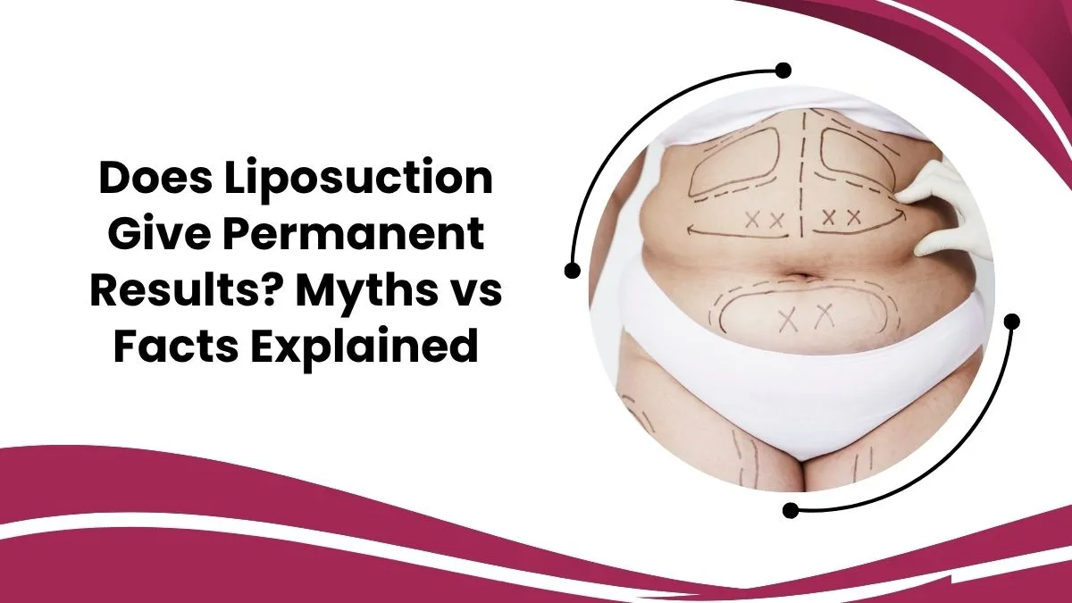 Does Liposuction Give Permanent Results? Myths vs Facts Explained