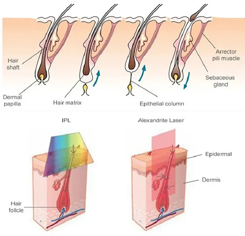 What Is the Laser Hair Removal Machine for All Skin Types?