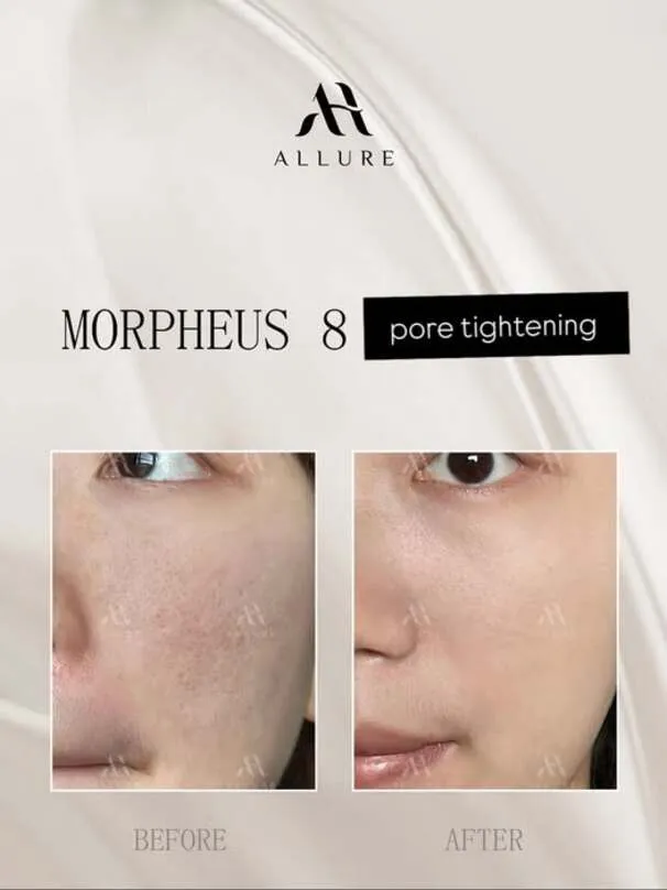 Is Morpheus 8 Treatment the Best Option for Skin Rejuvenation?
