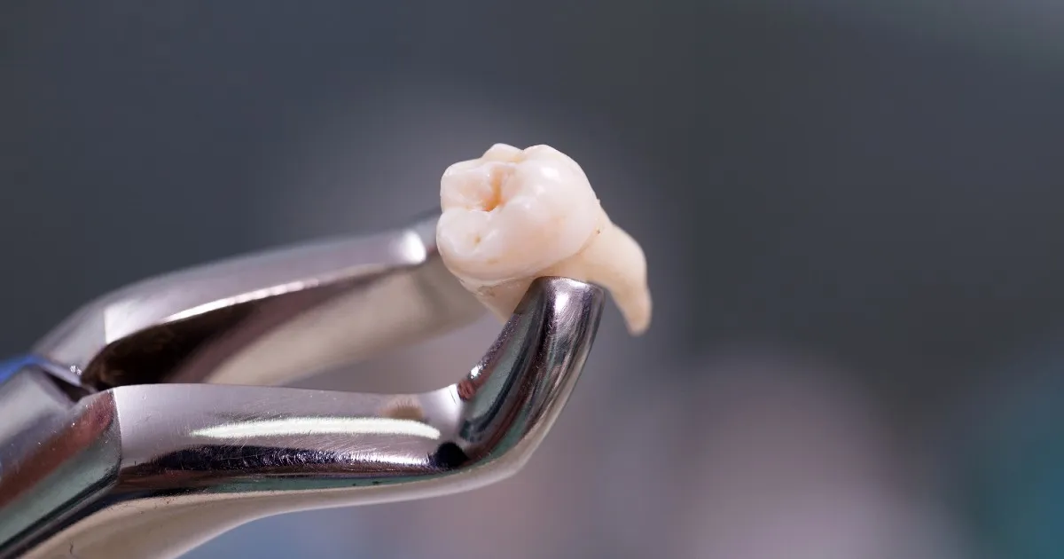 Painless Tooth Extraction for Kids: How Modern Dentistry Reduces Fear