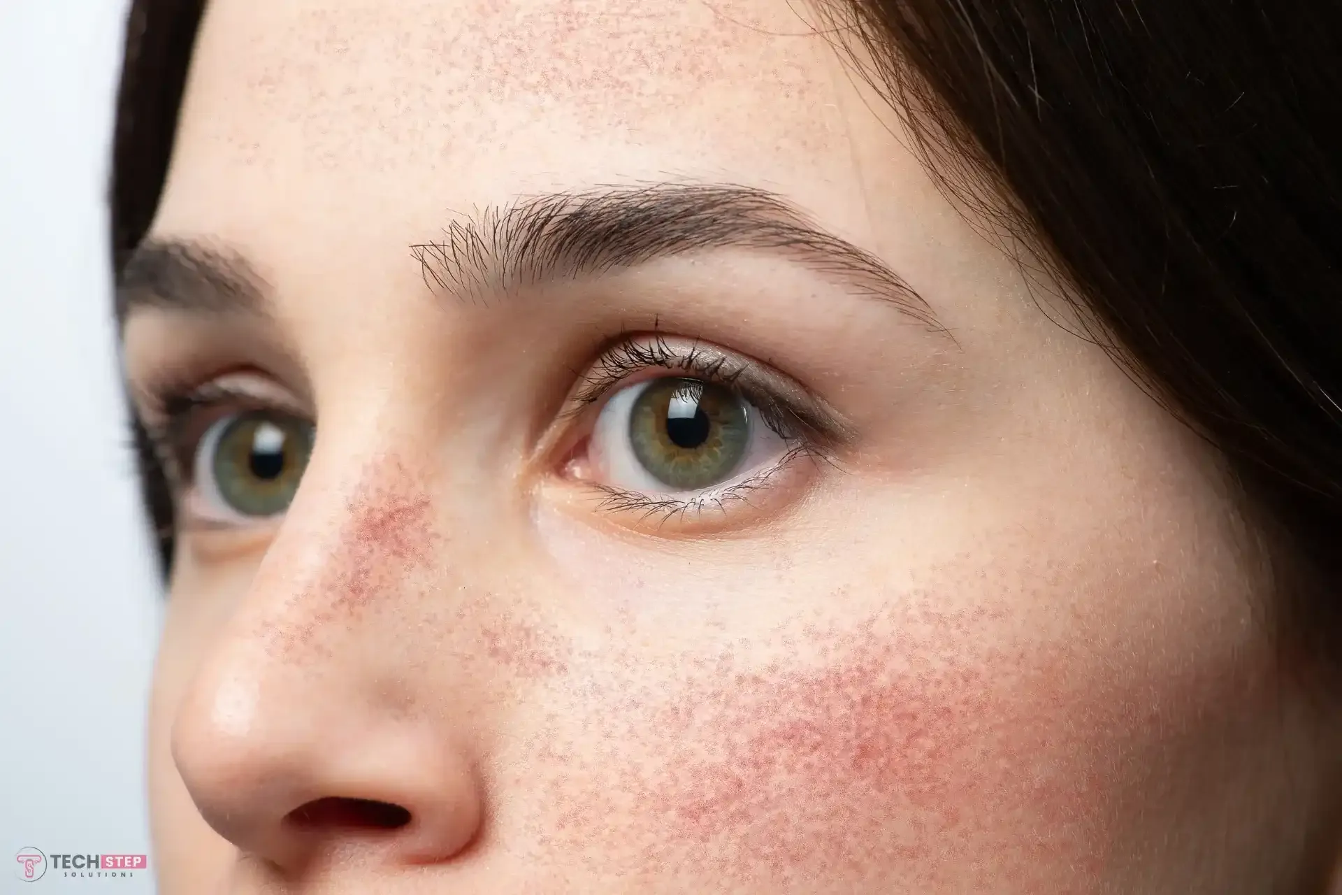 Rosacea Treatment Houston: Calm Redness and Restore Your Skin